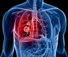 COPD