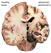 Alzheimer's healthy brain advanced alzheimer's 